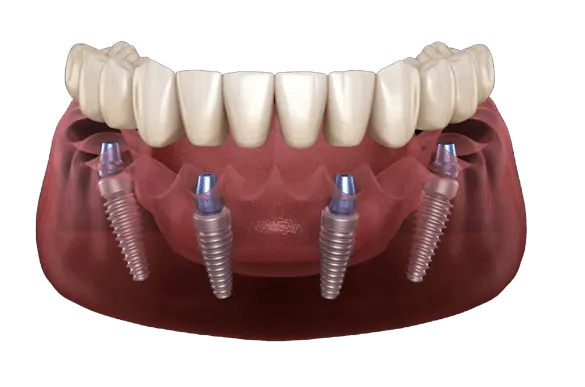 Full arch dental implants , otherwise known as All-on-4 treatment, at Anzac Avenue Dental Kallangur