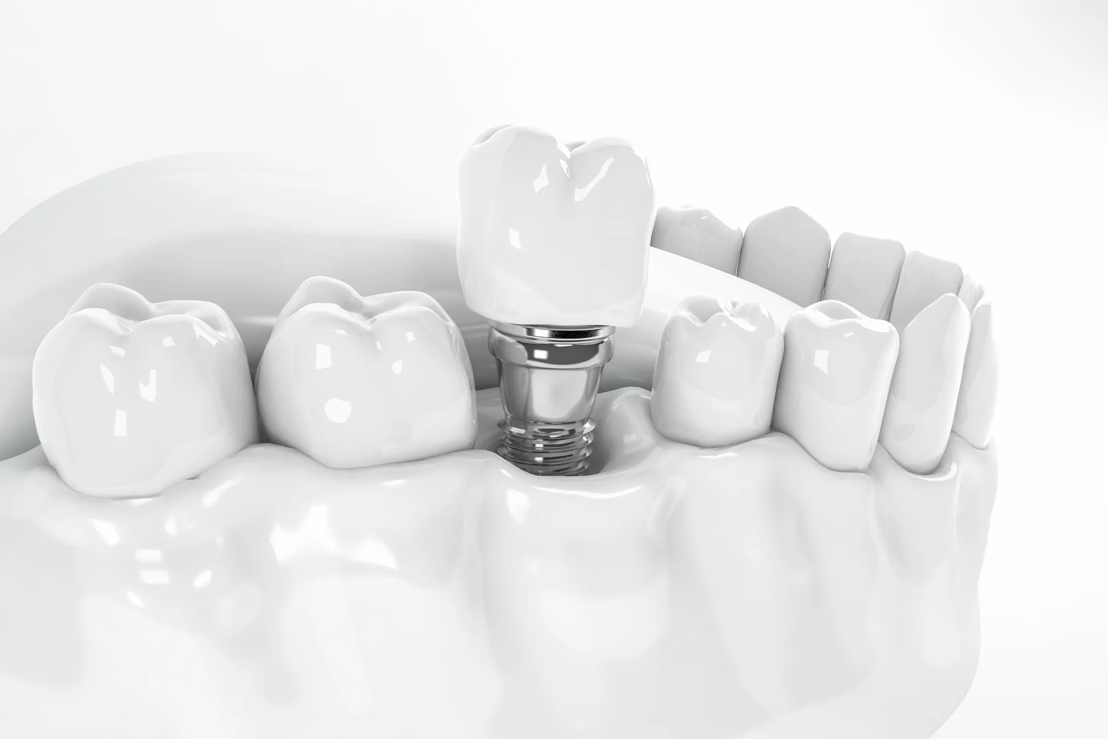 3D illustration of a dental implant in the lower jaw at Anzac Avenue Dental, Kallangur