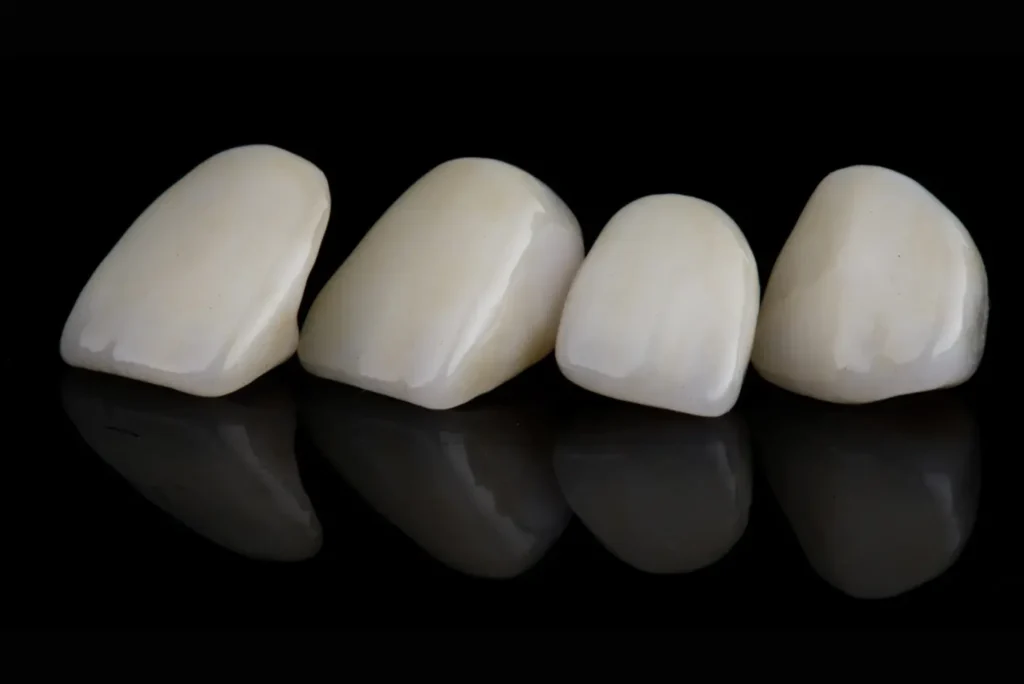 Four dental porcelain veneers displayed at Anzac Avenue Dental Kallangur