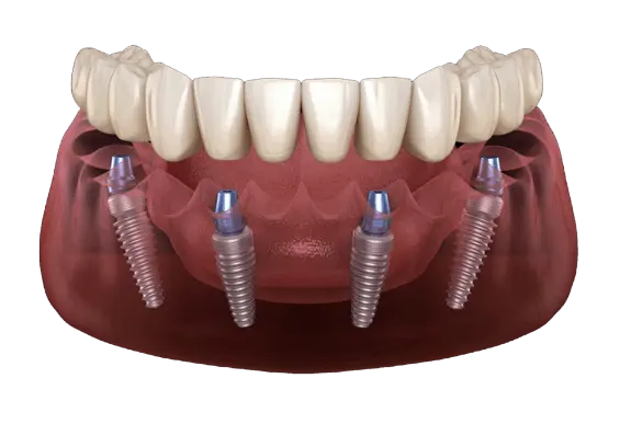 All-on-X dental implants replacing a full lower arch of teeth at Anzac Avenue Dental, Kallangur